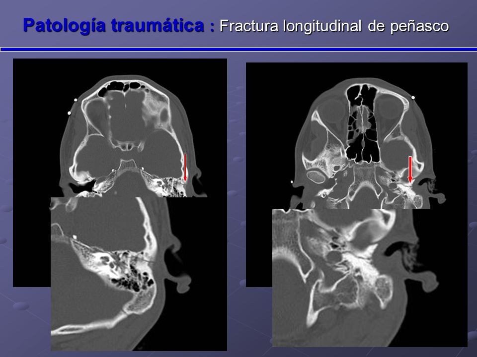 FRACTORA DE MASTOIDES EPUB DOWNLOAD FRACTORA DE MASTOIDES EPUB DOWNLOAD